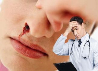 Epistaxis nasal: Sangrado de nariz - causas y tratamiento